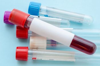 Hemocromatoza, diagnostic și tratament