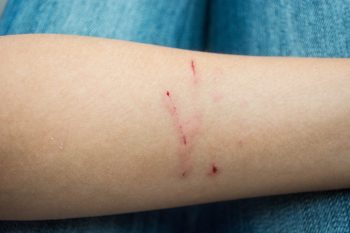 Boala ghearelor de pisică sau infecţia cu B. henselae