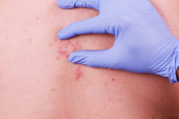 Infectia cu virus varicelo-zosterian: epidemiologie si tratament