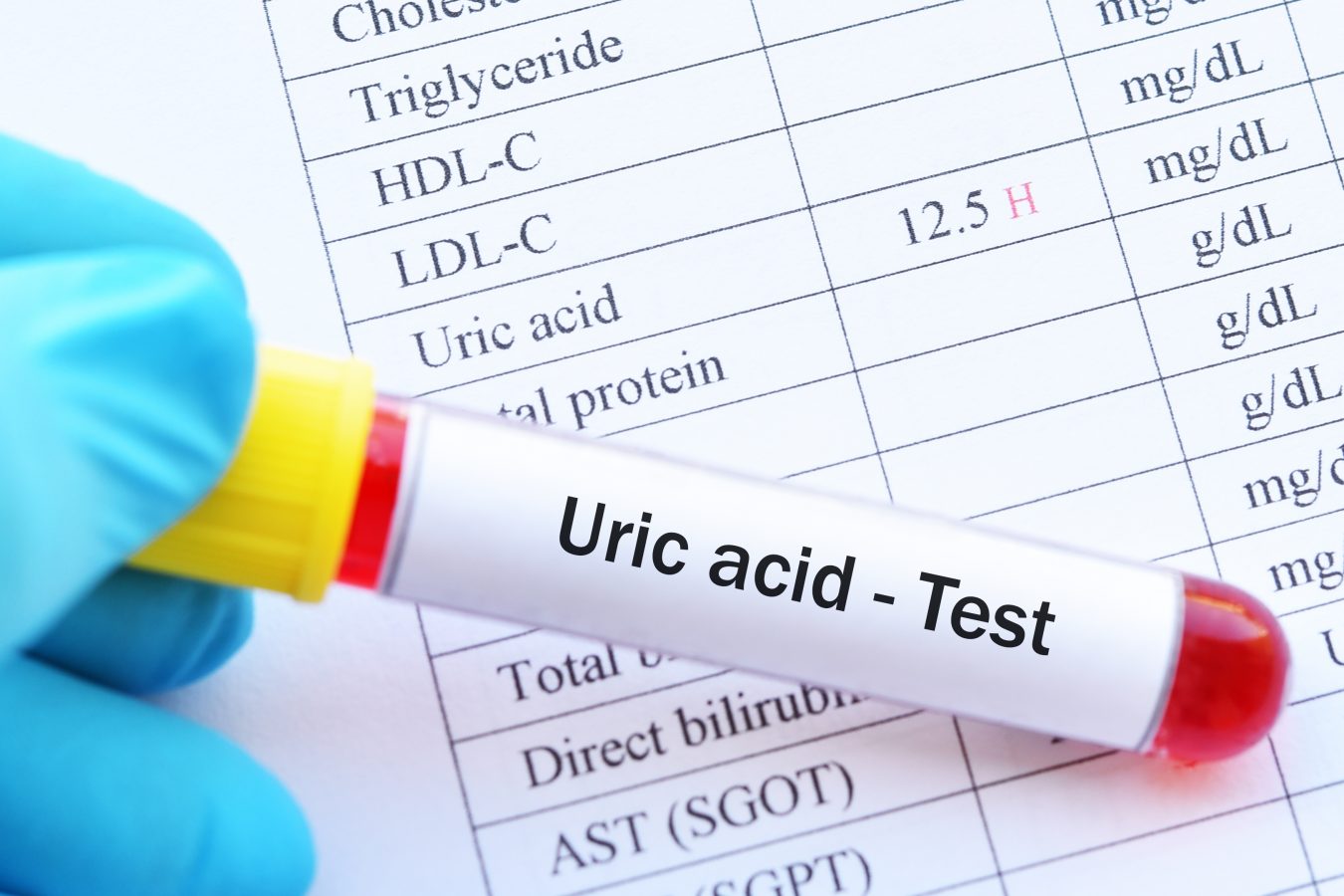 acid uric seric