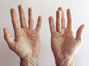 Boala Dupuytren, diagnostic si tratament