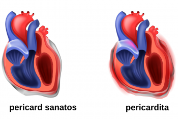 Pericardita acuta – etiologie, diagnostic si tratament