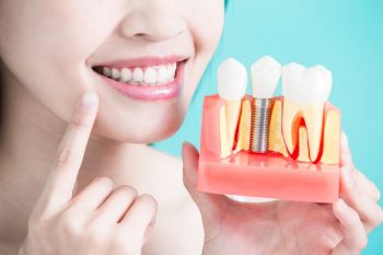 Implantul dentar, între rol și beneficii