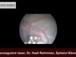 fotocoagulare laser - imagini microscop (2)