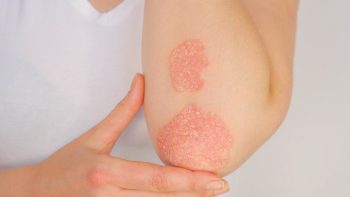 Psoriazisul: eczemele si terapia topica cu Mometazona Atb