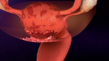 Endometrioza – etiologie, particularitati, tratament