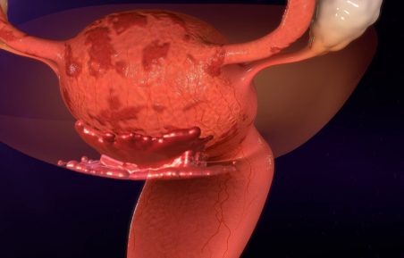 adenomioza