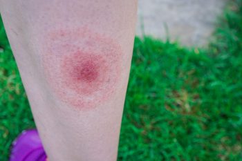 Infestarile cauzate de insecte si acarieni – simptome, diagnostic si tratament