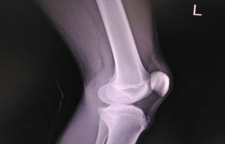 radiografie genunchi