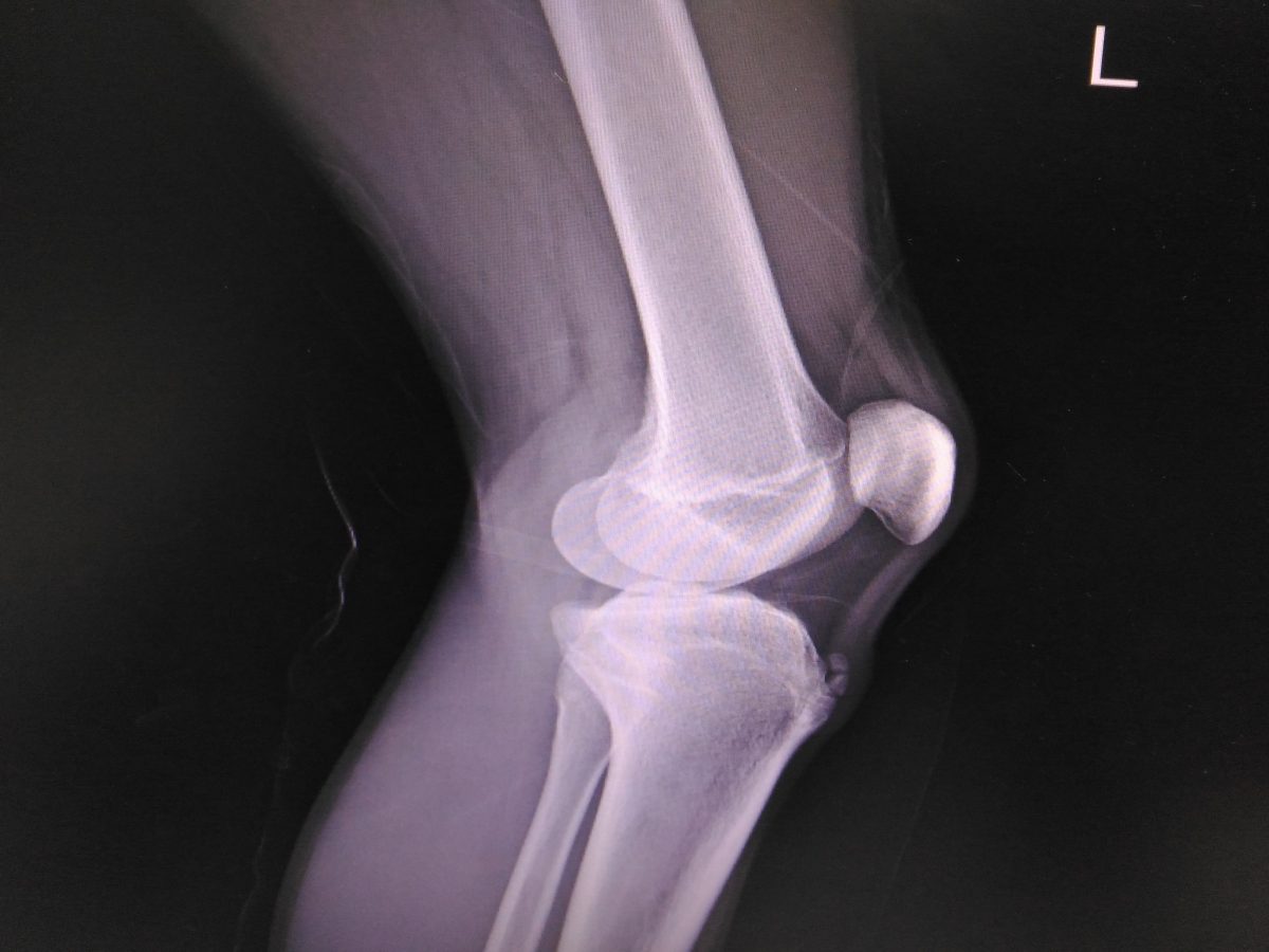 strângerea genunchiului în timpul tratamentului de extensie)