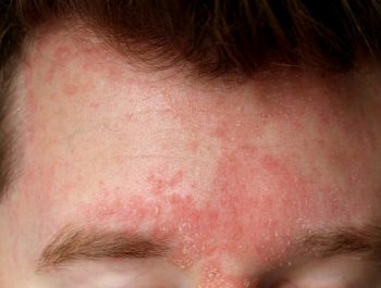 Dermatita seboreica – diagnostic si metode de tratament