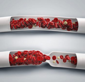 Ateroscleroza şi efectul ei neurodegenerativ asupra creierului