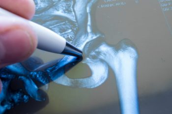 Osteoporoza și lipsa vitaminei D