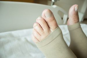 Varice sau vene varicoase: cauze, simptome si tratament | Bioclinica