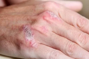 Afecțiuni dermatologice frecvent întâlnite la pacienții geriatrici
