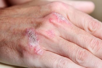 Afecțiuni dermatologice frecvent întâlnite la pacienții geriatrici