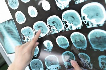Cercetătorii au descoperit un nou tip de neuron
