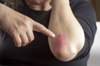 Severitatea psoriazisului și riscul de deces