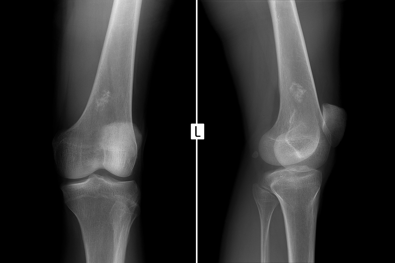 osteocondensare umar crema pentru bursita articulației genunchiului