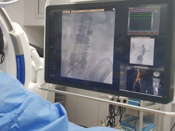 Noi tehnologii în tratamentul minim-invaziv al anevrismului de aortă abdominală