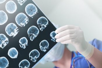 Glioblastomul, o tumoră cu prognostic rezervat
