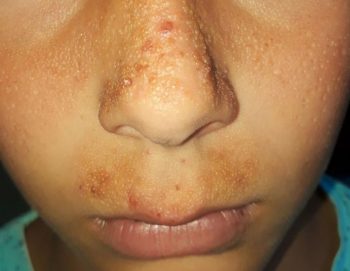 Primul caz de Milium Coloid Juvenil a fost diagnosticat în România