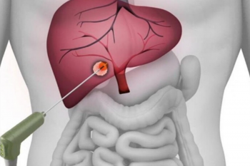 Rezecția chirurgicală a metastazelor, o şansă pentru pacienţii cu cancer