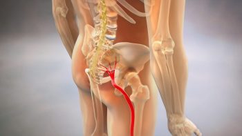 Sciatica: un simptom prezent în mai multe afecțiuni