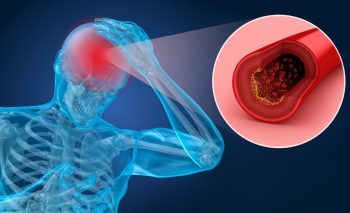 Recuperarea după accidentul vascular cerebral