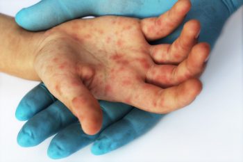 Un nou medicament ar putea trata boala gură-mână-picior
