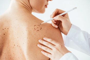 Un nou instrument în lupta împotriva melanomului