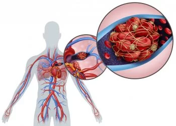 Tromboembolismul pulmonar, aspecte multidisciplinare