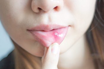 Aftele bucale, cele mai întâlnite tipuri de ulcere