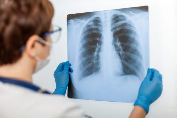 CT-ul pulmonar, factor-cheie în recuperarea post-COVID-19