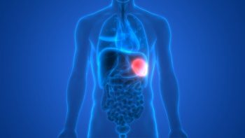 Splenomegalia sau mărirea splinei, o afecţiune de multe ori asimptomatică