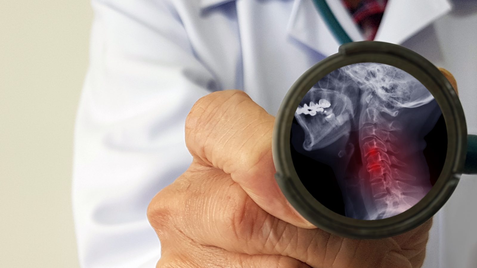 Spondiloza cervicală: diagnostic și tratament - Revista Galenus