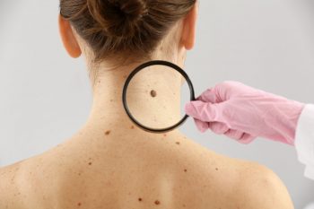 Studiu: Metaboliţii sunt implicaţi în apariția melanomului