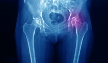 Osteonecroza avasculară, dureroasă și progresiv invalidantă