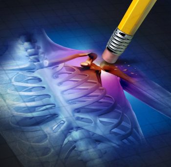 Periartrita scapulohumerală sau periartrita umărului