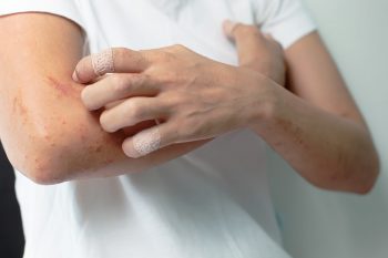 9 mituri despre psoriazis