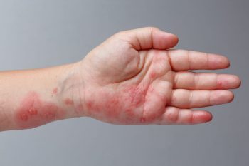 Zona zoster, obiectivele farmacoterapiei
