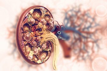 Metoda de testare a probabilităţii de respingere a transplantului de rinichi