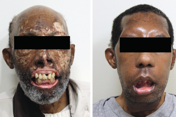 Povestea primului afro-american cu transplant de față