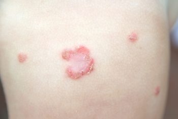 Impetigo, o infecție cauzată de stafilococul auriu