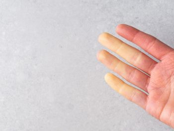 Sindromul Raynaud sau întreruperea fluxului sangvin la extremități