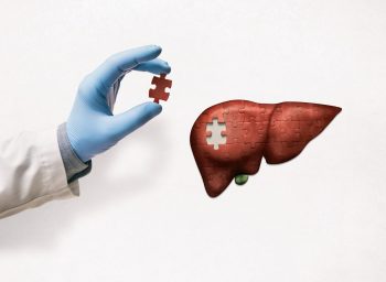 Encefalopatia hepatică dezvoltată pe fondul cirozei hepatice