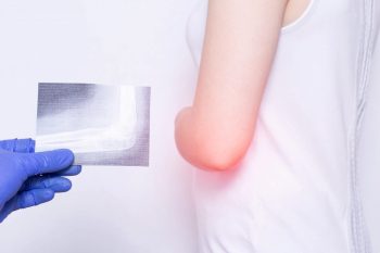 Sindromul de tunel cubital, neuropatia de compresie a membrului superior