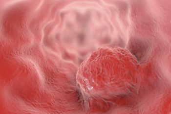 Esofagul Barrett, precursorul adenocarcinomului esofagian