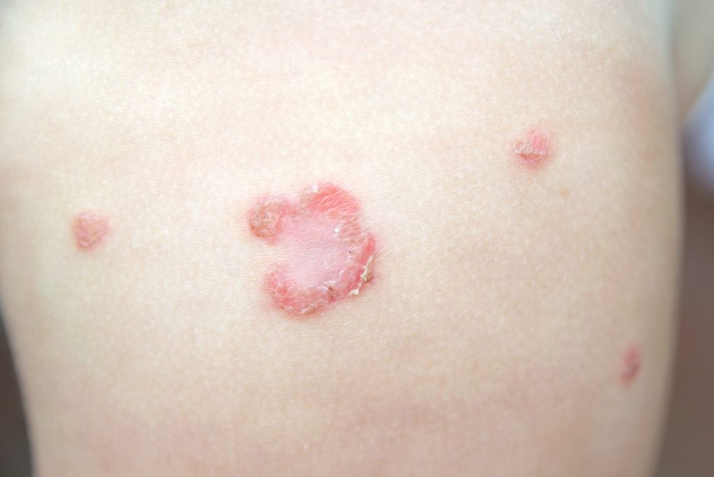 impetigo