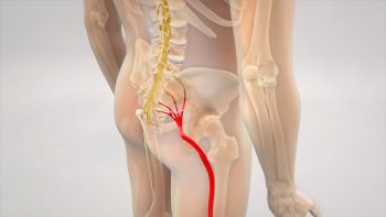 Durerea nervului sciatic - Sciatica